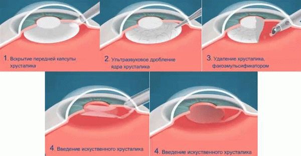 Восстановление зрения после операции по удалению катаракты:
